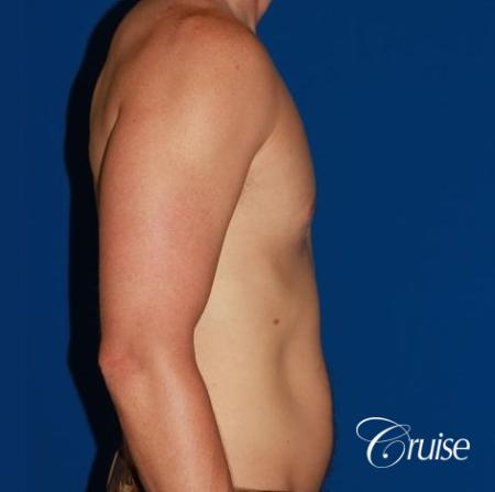 puffy nipple on low body fat - After Image 5