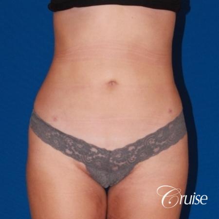liposuction love handles and tummy - After Image 1