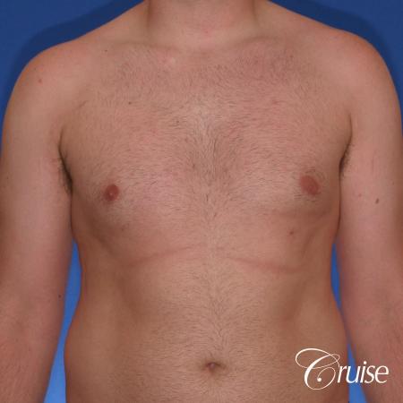 best Puffy nipple correction and gynecomastia on young adult - After Image 1