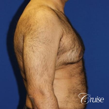 40 year old with severe gynecomastia results - Before and After Image 3