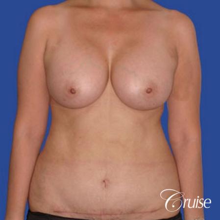 best mini mommy makeover with silicone breast implants - After Image 1