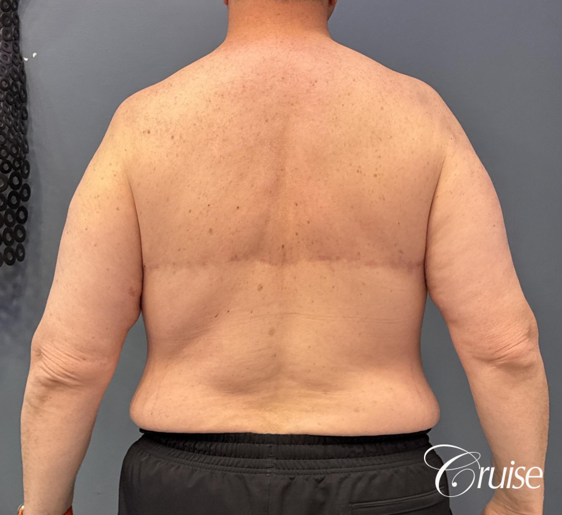 Gynecomastia Type 6; Circumferential Upper Body Lift; Liposuction to Upper Abdominal Rib Fat, Posterior Arms, Upper Back and Flanks - After 3