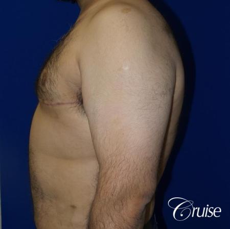 Gynecomastia -Free Nipple Graft - After Image 3