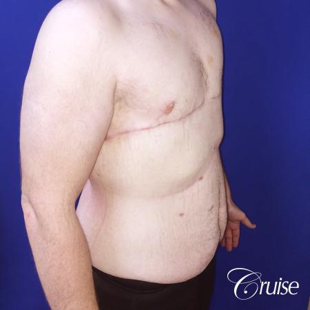 severe gynecomastia - After Image 3