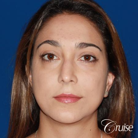 best medium chin implant on young patient - After Image 1