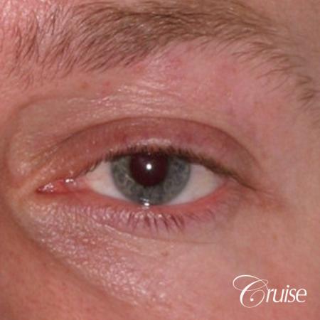 male soft tissue filler Juvaderm - After Image 1