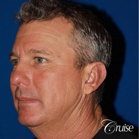 best pictures of otoplasty on male adult - After Image 2
