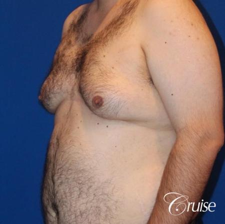 gynecomastia with free nipple graft - Before Image 2