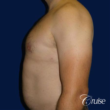 male breast reduction surgery - After Image 3