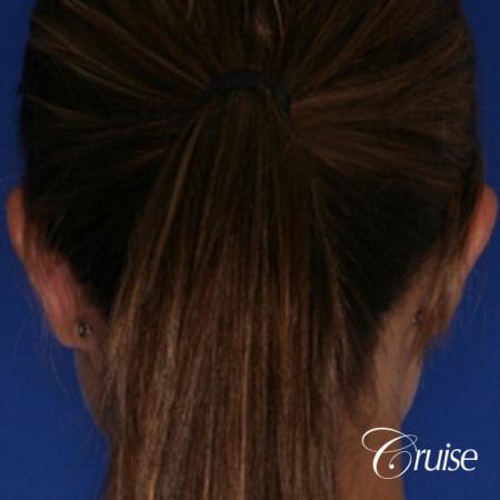 best otoplasty on adolescent - After Image 2