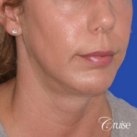 best medium anatomic chin implant on female - After Image 3