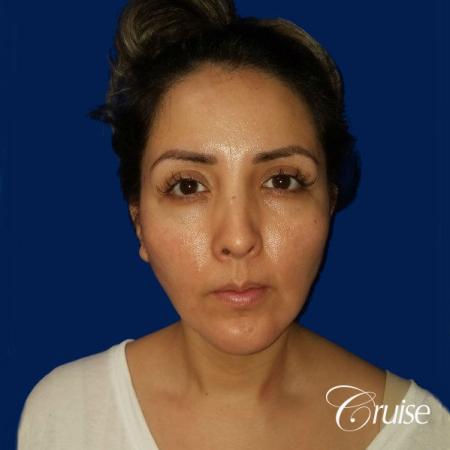 Liposuction of Neck/Jawline - After Image 1