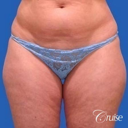 best liposuction abdomen, flanks and thighs - Before Image 1