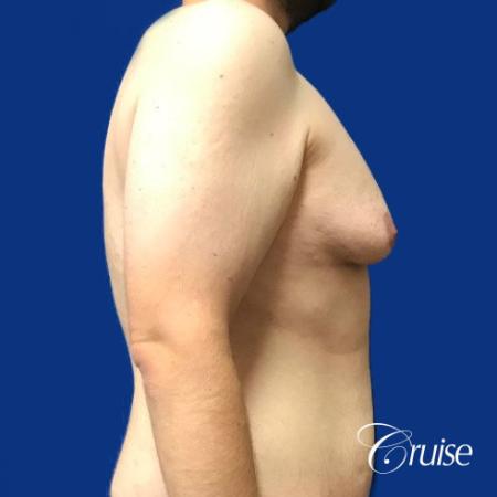 Pedicle incision Dr. Cruise Newport Beach CA - Before Image 4