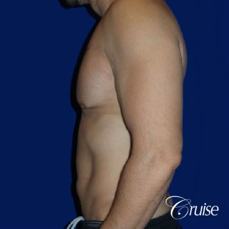 Moderate Gynecomastia -Pedicle - Before Image 2