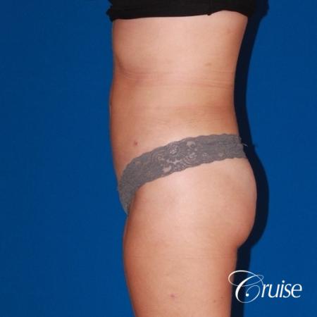 liposuction love handles and tummy - After Image 3