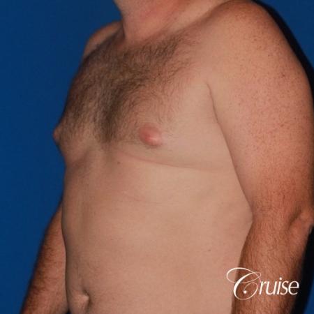 mild puffy nipple on 42 year old - Before and After Image 3