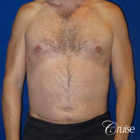 Best Gynecomastia surgeons Los Angeles - After Image 1