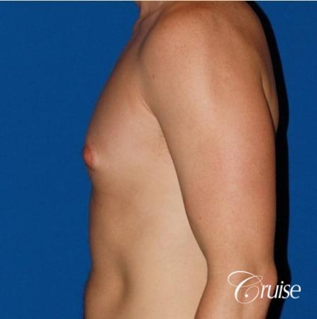 puffy nipple on 35 yr old male - Before Image 2