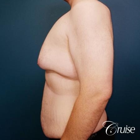 severe gynecomastia - Before and After Image 4