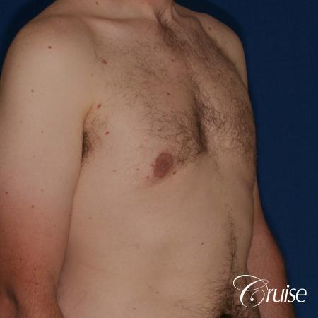 adult male with moderate gynecomastia gets donut lift - After Image 5
