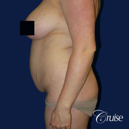 Best tummy tucks dr cruise - Before Image 2
