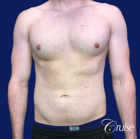 Moderate Gynecomastia -Areola Incision - Before Image 1