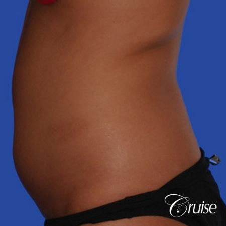 fast way to get with of love handles with liposuction flanks - Before and After Image 2