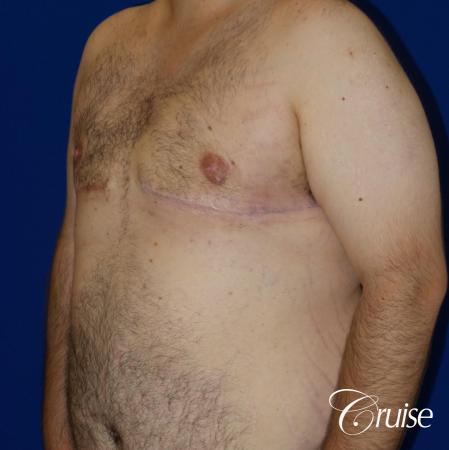 gynecomastia with free nipple graft - 1 After Image 2