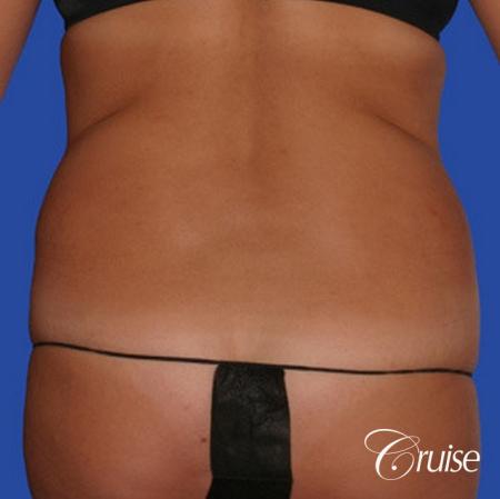 pictures of love handle liposuction - Before Image 1