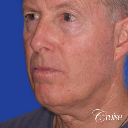 62 year old with chin implant and neck lift - Before Image 2