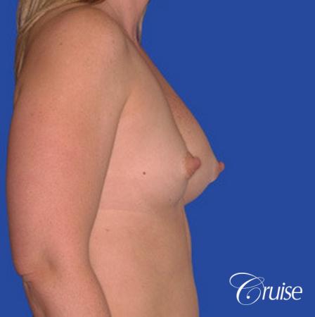 saline implant rupture newport beach plastic surgeon - Before and After Image 2