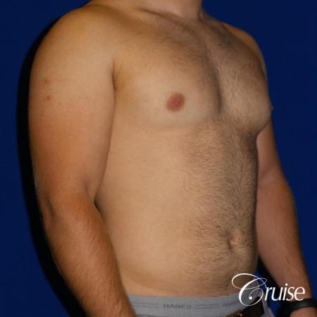 best gynecomastia results - Before Image 4