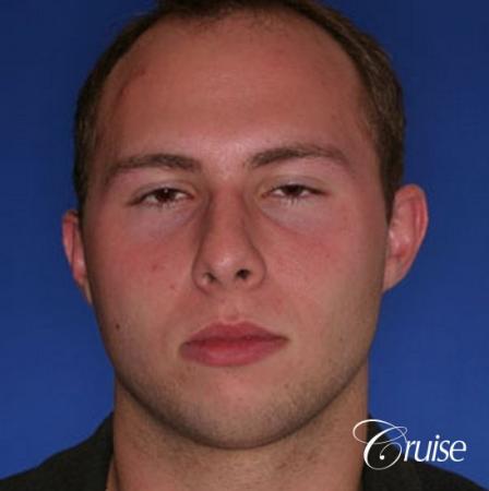 best chin implant on male with medium square jaw - Before Image 1