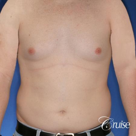 moderate chest gynecomastia and liposuction flanks - Before Image 1