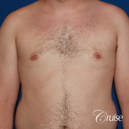 asymmetric gynecomastia moderate - After Image 1