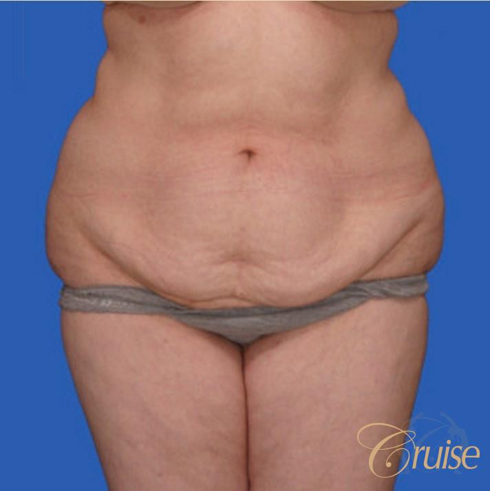 best extended abdominoplasty incision - Before 1