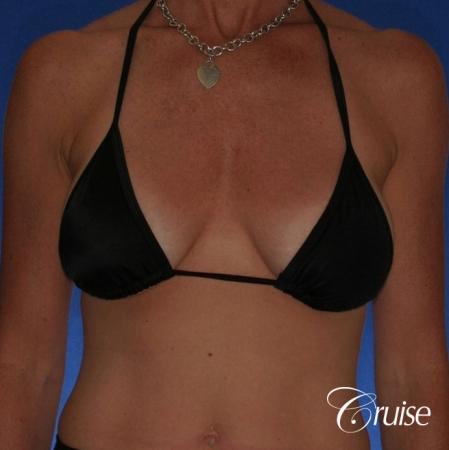 Best breast revision for low implants - Before Image 4
