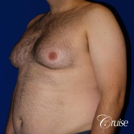 Severe Gynecomastia- Free nipple Graft - Before Image 2