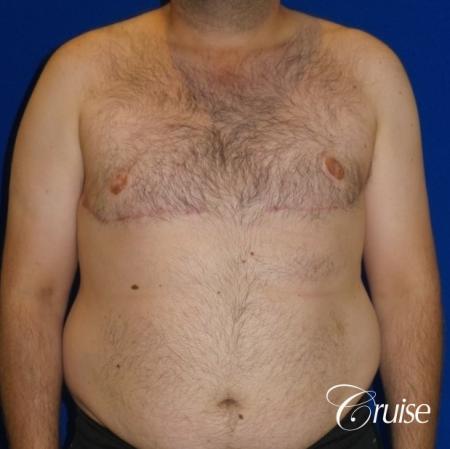 Severe Gynecomastia- Free nipple Graft - After Image 1