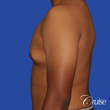 24 yr. old gets gynecomastia surgery with best scars - Before Image 2
