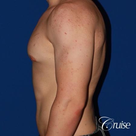 mild-gynecomastia-revision - Before Image 2