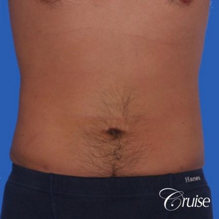 best liposuction to contour a males body - After Image 1
