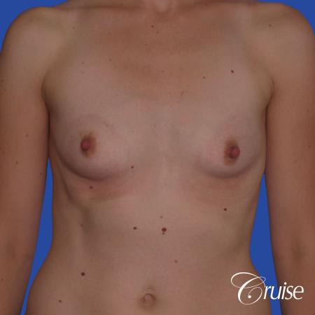 Breast Augmentation - Before Image 1