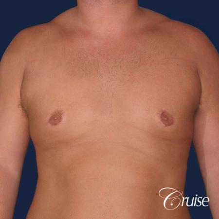 donut lift Gynecomastia correction - After Image 1