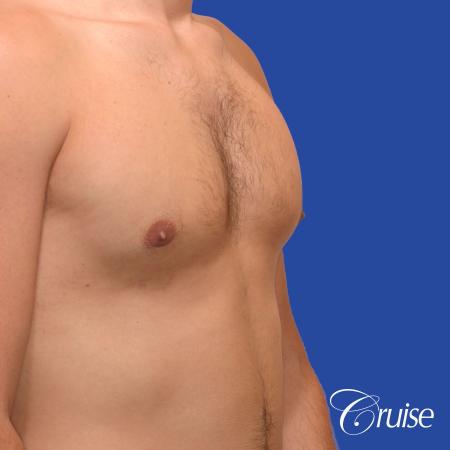 24 yr old body builder mild gynecomastia - After Image 3