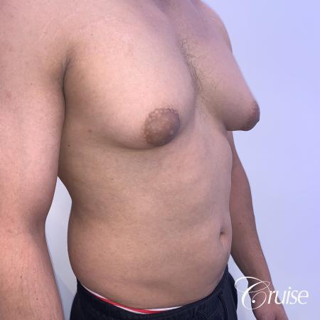 gynecomastia surgery - Before and After 5