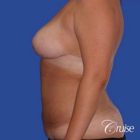 best before and after of liposuction abdomen, flanks, and upper back - After Image 2