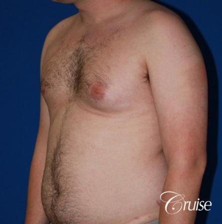 asymmetric gynecomastia moderate - Before Image 2