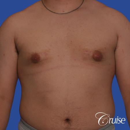 best scars for moderate gynecomastia - Before Image 1